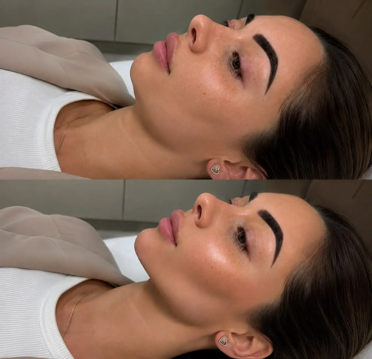 Facial Balancing & Skin Boosters treatment result at Sculpt Faces