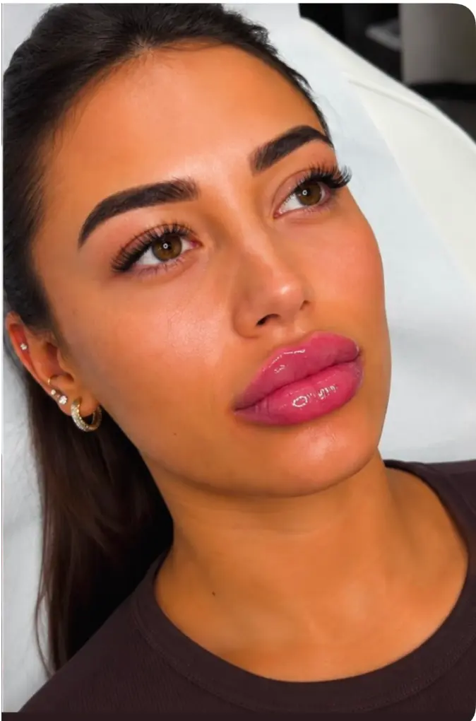 Defined Lip Enhancement treatment result at Sculpt Faces
