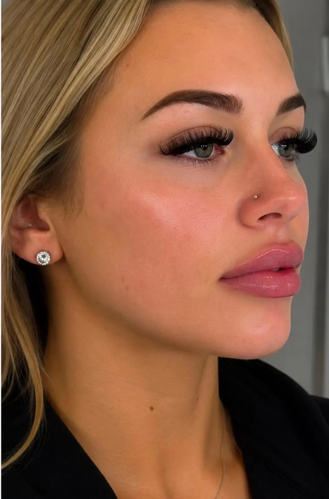 Natural Lip Enhancement treatment result at Sculpt Faces