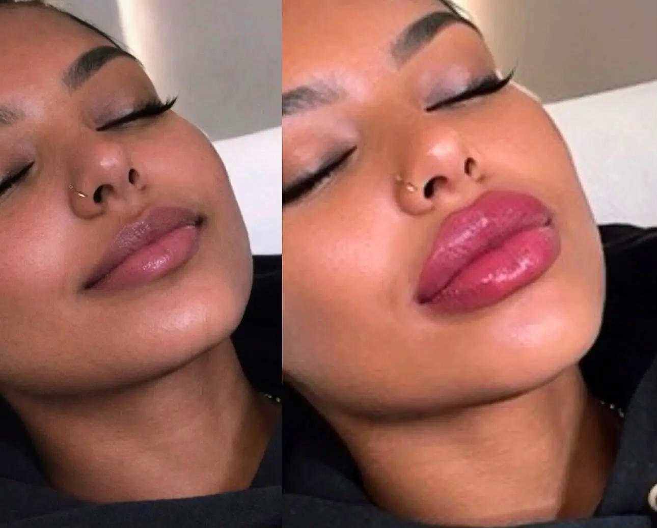Lip Enhancement result at Sculpt Faces