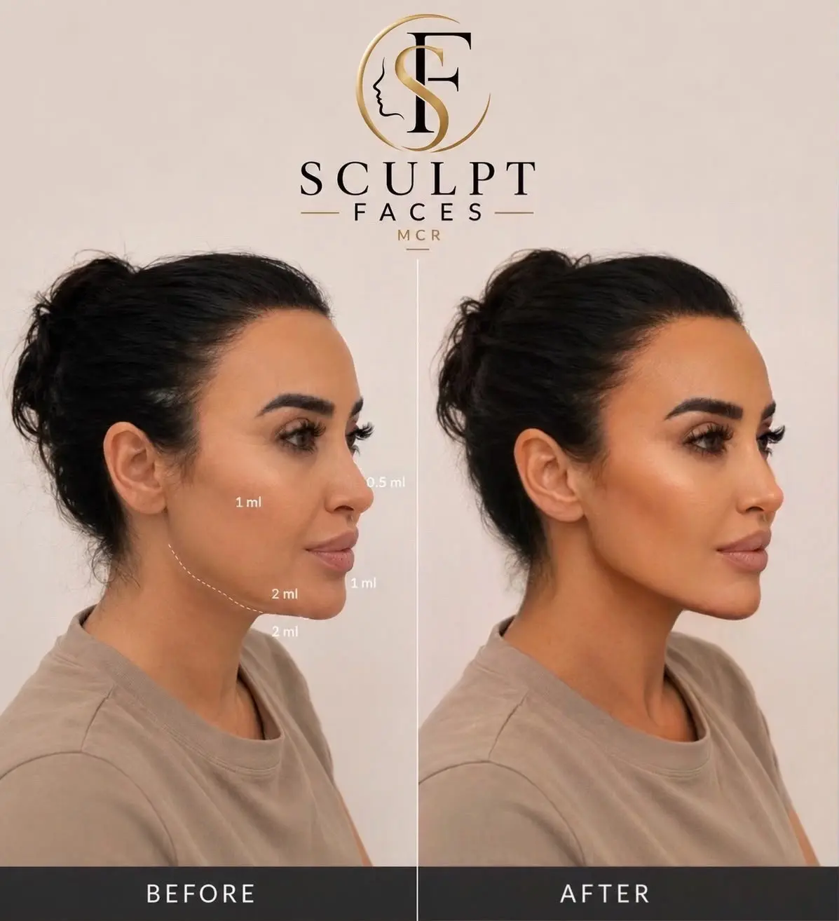 Facial Balancing result at Sculpt Faces