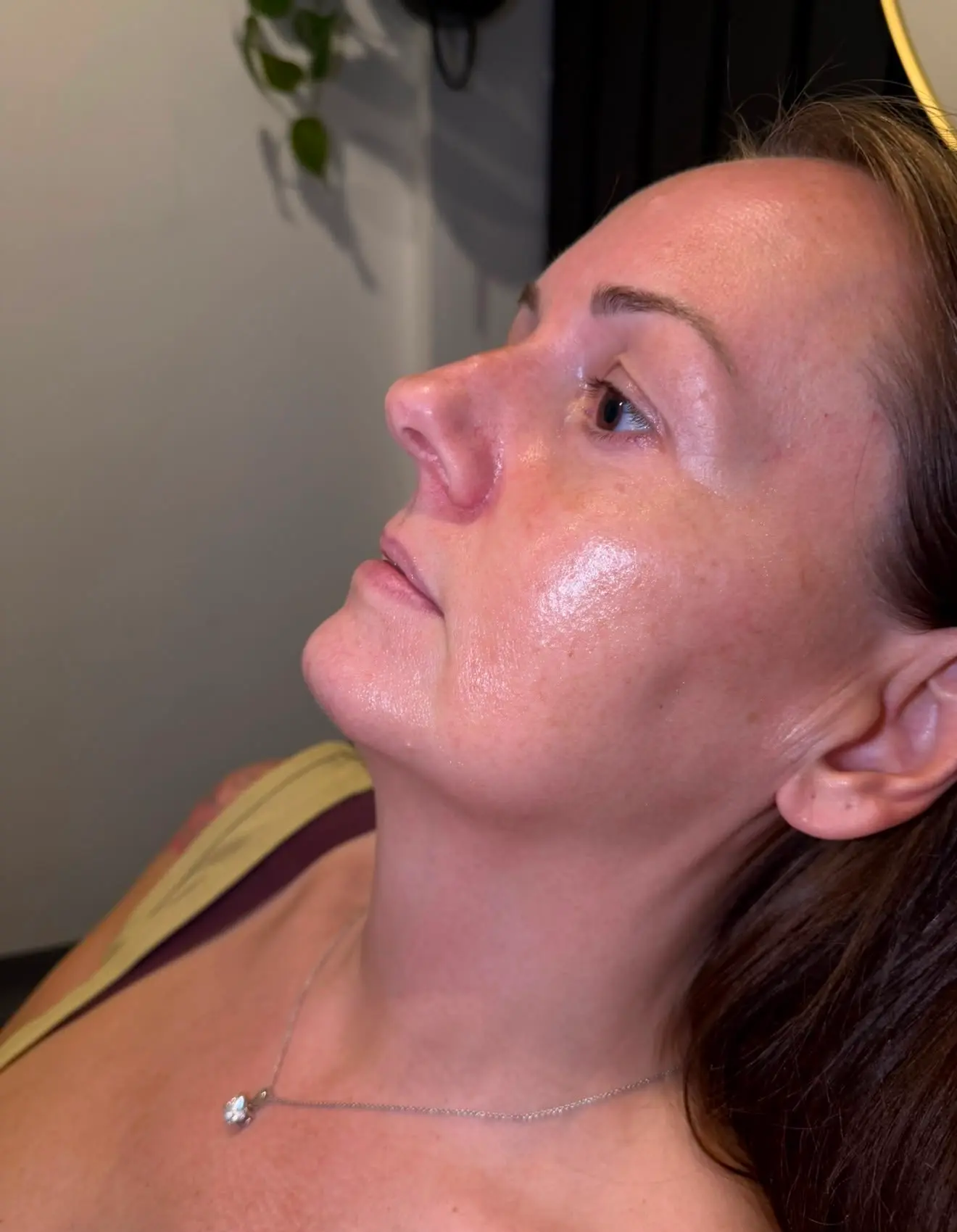 Skin Booster Glow treatment result at Sculpt Faces